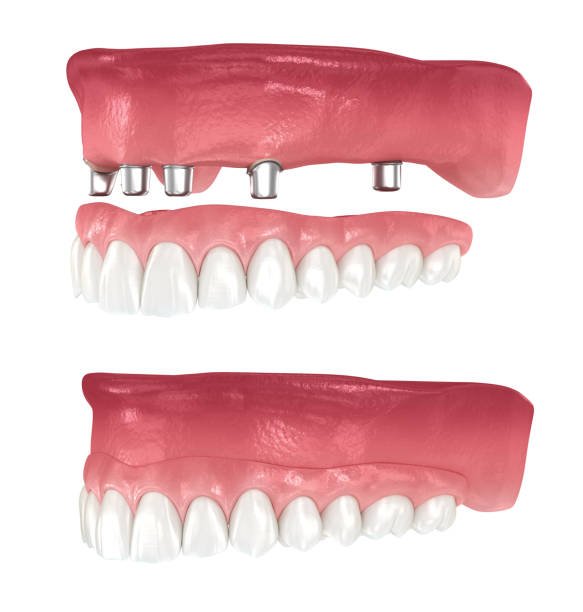 Full Mouth Rehabilitation